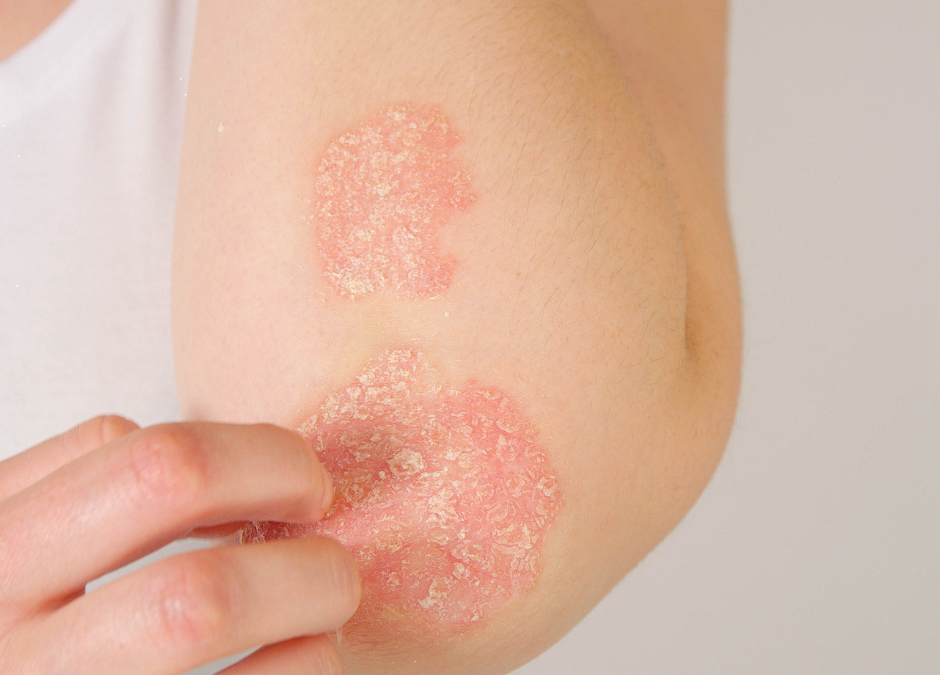 How Ayurveda can help with Psoriasis