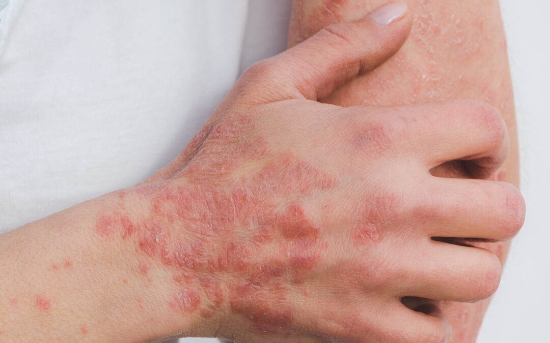 Ayurveda Treatment That Makes Autoimmune Diseases Curable