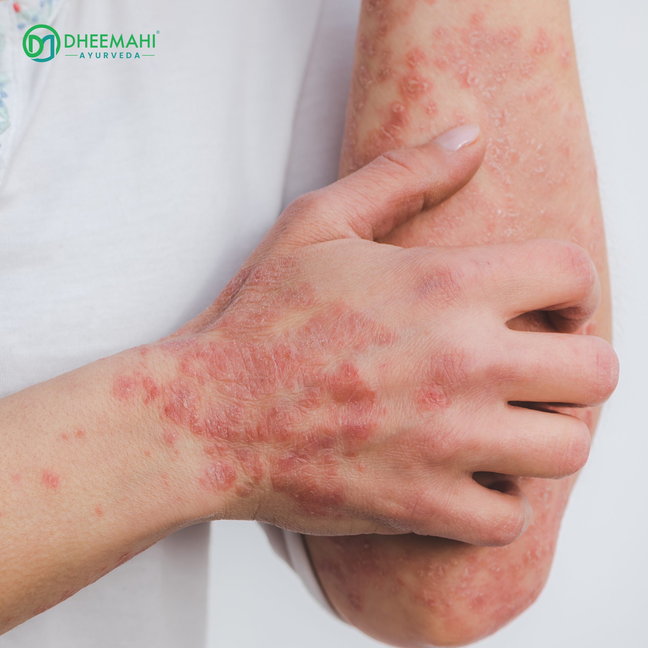 Are Autoimmune Diseases Curable What Science and Ayurveda Say A close-up image of a person's arm and hand with red, inflamed, scaly skin patches, indicating a skin condition like psoriasis or eczema. The person is scratching the affected area. The Dheemahi Ayurveda logo is visible in the top-left corner, suggesting Ayurvedic treatment support.