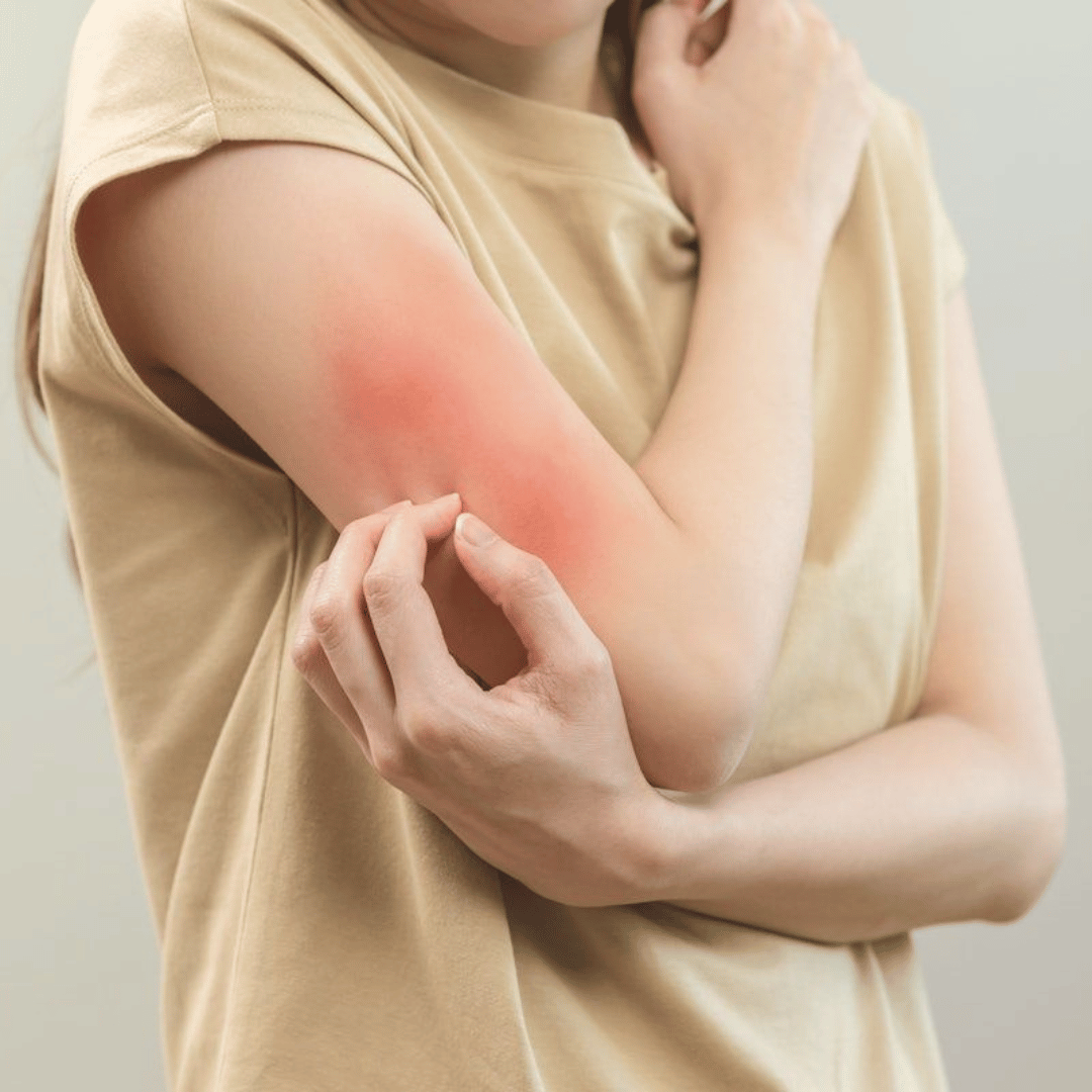 A person wearing a beige t-shirt is scratching their red, inflamed, and irritated skin on the inside of their elbow.