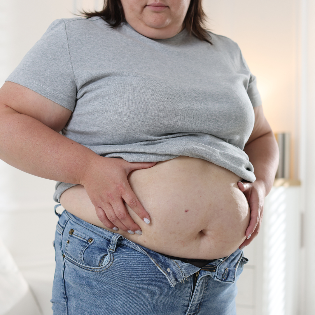 Belly Fat and Obesity – A Key Health Concern Overweight woman holding belly fat, showing abdominal obesity and health concerns.