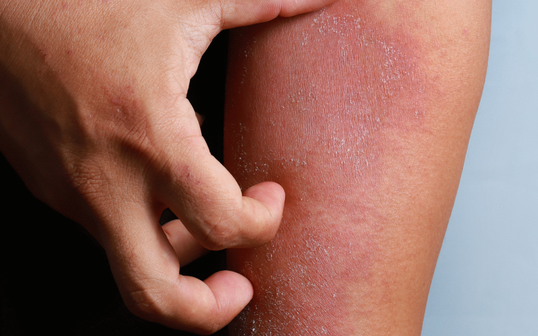 What Is The Right Ayurvedic Treatment For Eczema?