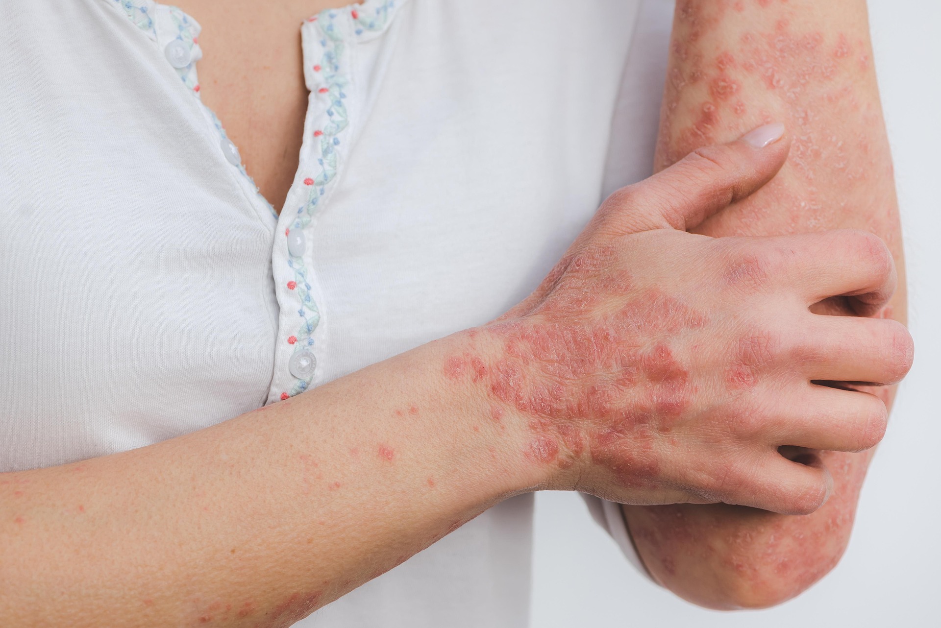 Ayurvedic Healing for Skin Diseases | Natural Psoriasis & Eczema Relief Close-up of a person’s arm and hand showing red, scaly skin patches, representing common skin diseases such as psoriasis or eczema.