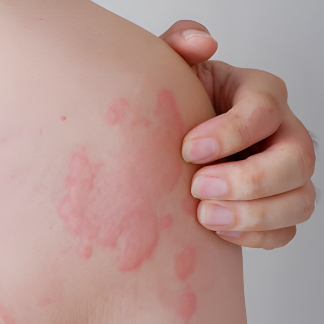 Red itchy patches on the skin showing symptoms of urticaria treated effectively through Ayurveda therapies and natural healing methods.