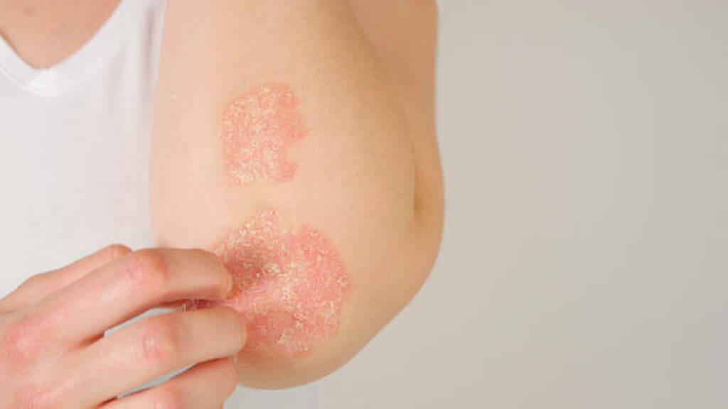 A close-up of red, scaly psoriasis patches on the elbow, showing skin inflammation commonly treated with Ayurvedic healing methods.