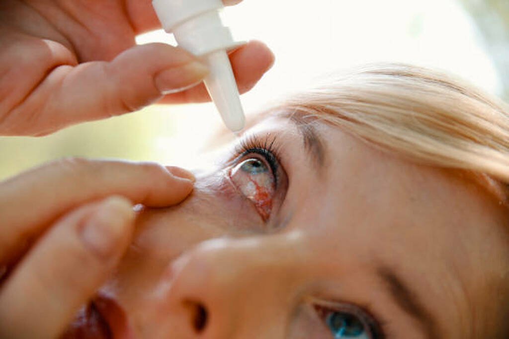 Person applying eye drops to treat a red, irritated eye as part of natural treatment for eye infection.